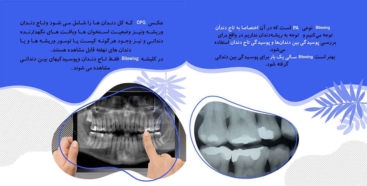 انواع-رادیوگرافی-دندان