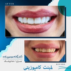 لمینت کامپوزیتی دندانی