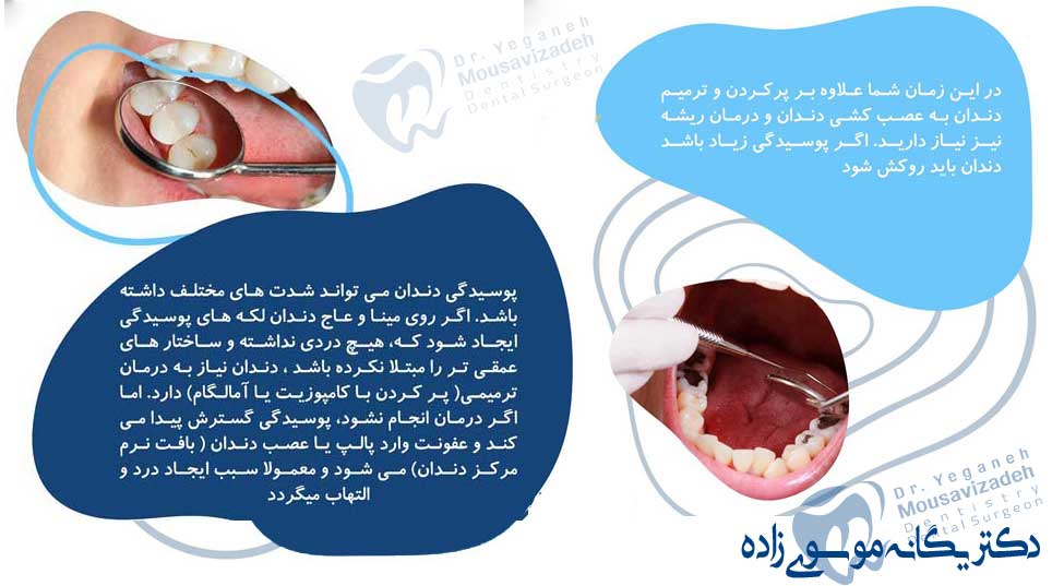 درمان-پوسیدگی-دندان