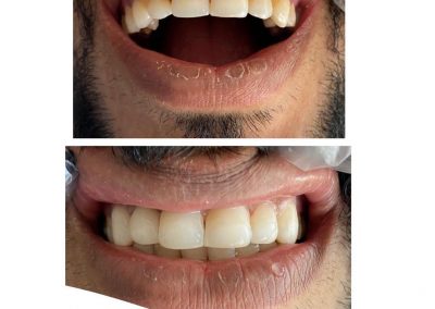 ترمیم کامپوزیت ۶ دندان قدامی که دارای پوسیدگیهای ناحیه سرویکال