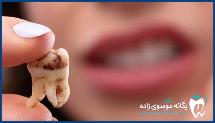 مهم‌ترین علت پوسیدگی دندان 
