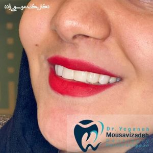 ونیر کامپوزیت دندان های قدامی بالا 2