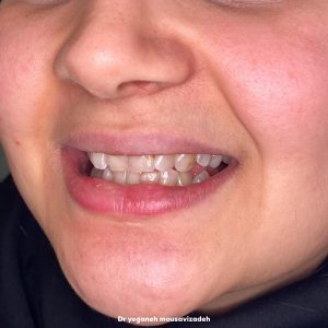 ونیر کامپوزیت ۸ دندان قدامی بالا با رنگ بلیچ4