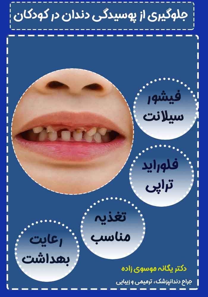 جلوگیری-از-پوسیدگی-دندان-در-کودکان