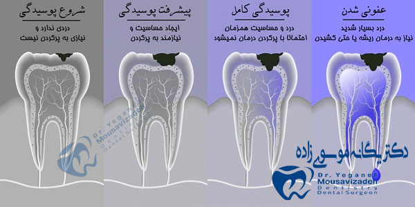 پیشرفت-پوسیدگی-دندان-و-درمان-ریشه