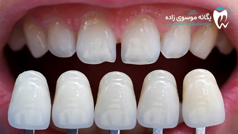 لمینت دندان
