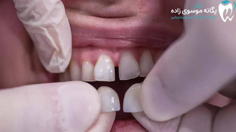 کامپوزیت دندان