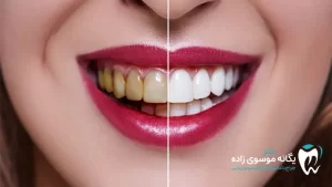 تفاوت ونیر کامپوزیت و لمینت دندان