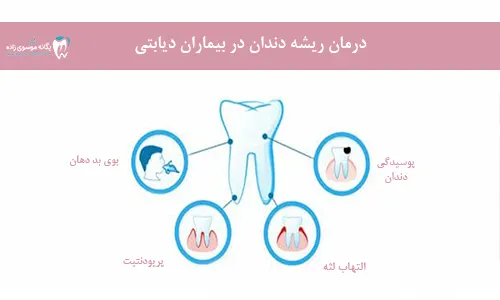 درمان ریشه دندان در بیماران دیابتی