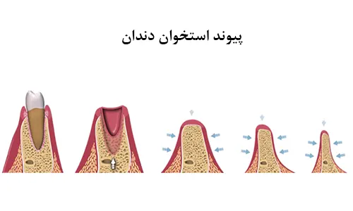 پیوند استخوان دندان