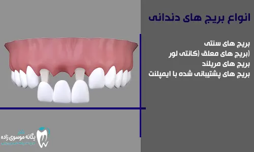 انواع بریج های دندانی