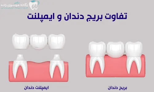 تفاوت بریج دندان و ایمپلنت دندان