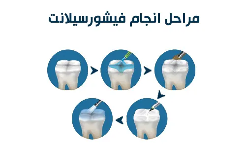 مراحل انجام فیشورسیلانت  