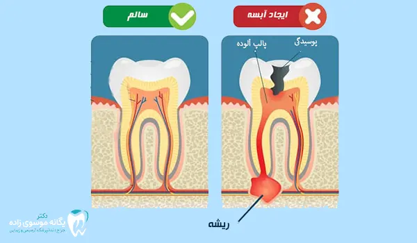 آبسه دندان و لثه کودکان