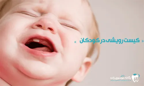 کیست دندانی در کودکان 