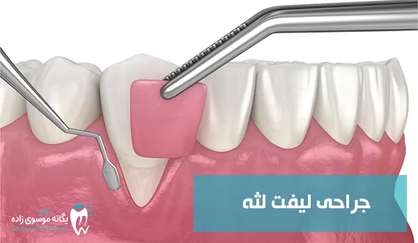 جراحی لیفت لثه