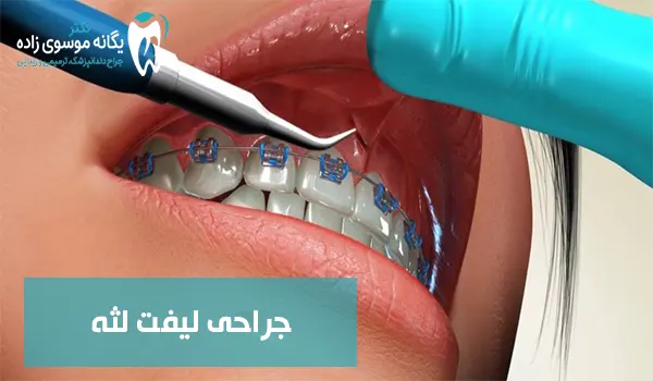 جراحی لیفت لثه
