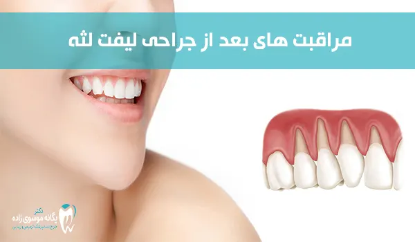 مراقبت های بعد از جراحی لیفت لثه