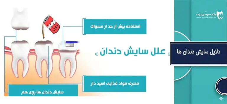 دلایل سایش دندان ها
