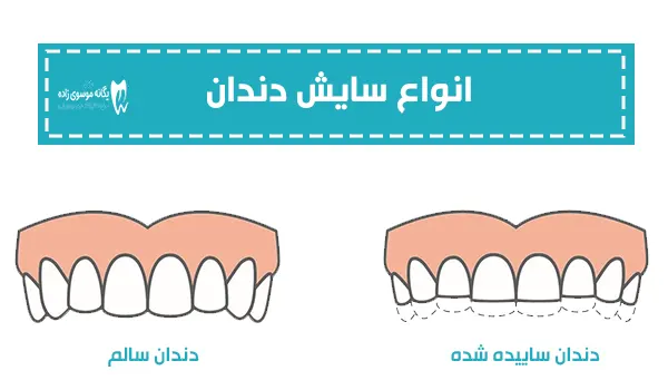 انواع سایش دندان