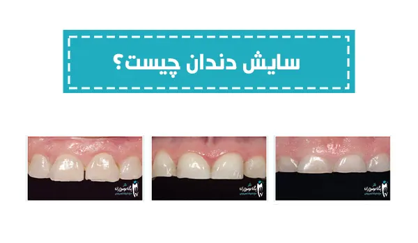 سایش دندان چیست؟