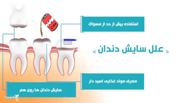 علل سایش دندان