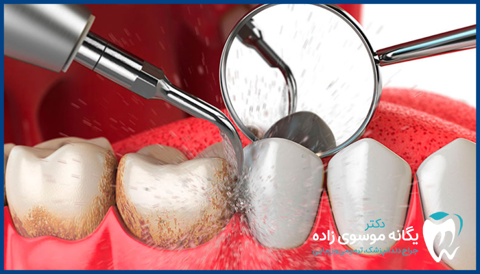 کاندیدای مناسب لیفت لثه با لیزر 