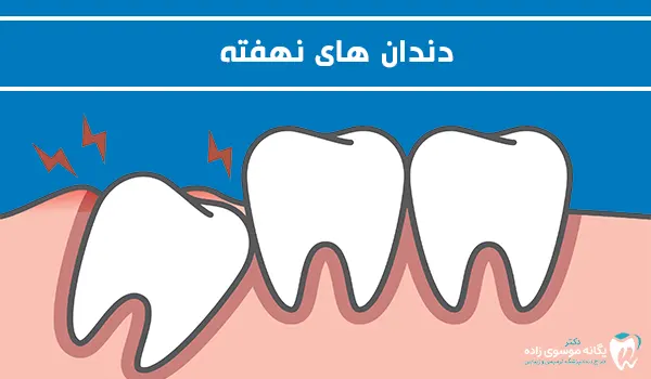 دندان های نهفته