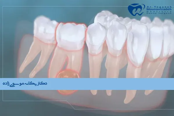 کیست دندانی چیست