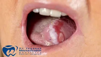 شیمی درمانی بر دهان و دندان چه عوارضی می گذارد؟