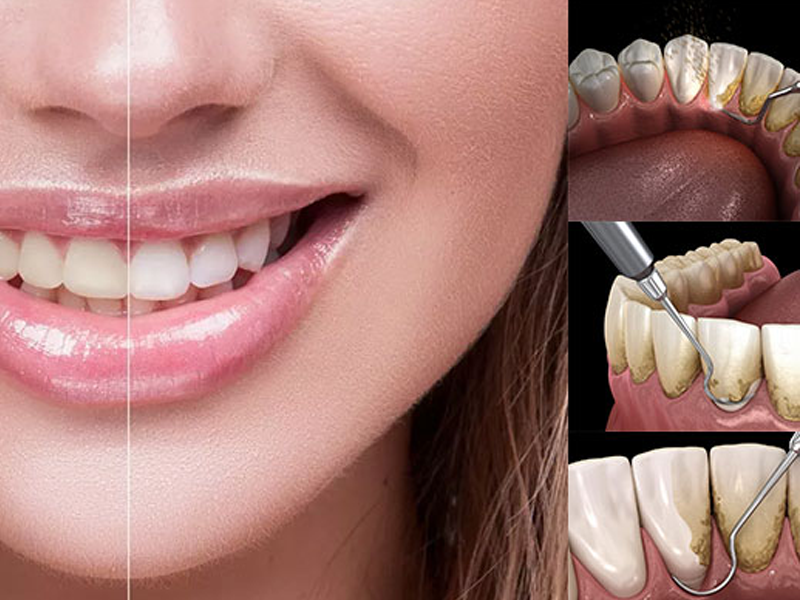 تفاوت بلیچینگ و جرم گیری
