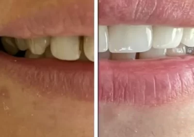 نمونه کار زیبایی دندان