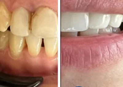 نمونه کار زیبایی دندان1