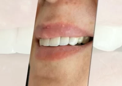 نمونه کار زیبایی دندان4