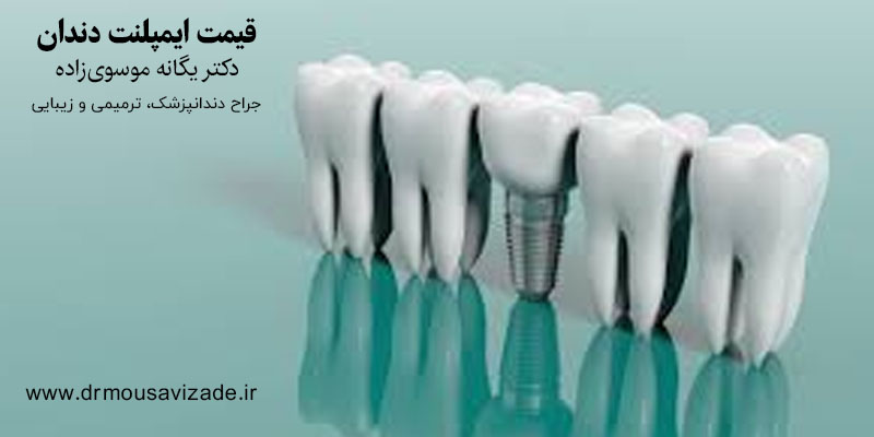 قیمت ایمپلنت دندان
