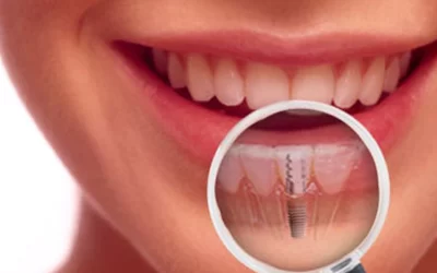 بهترین کاندیدای ایمپلنت دندان چه کسانی هستند؟