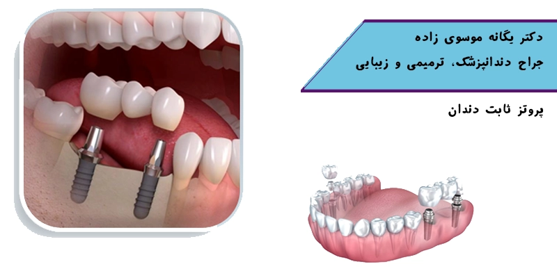 پروتز دندان ثابت