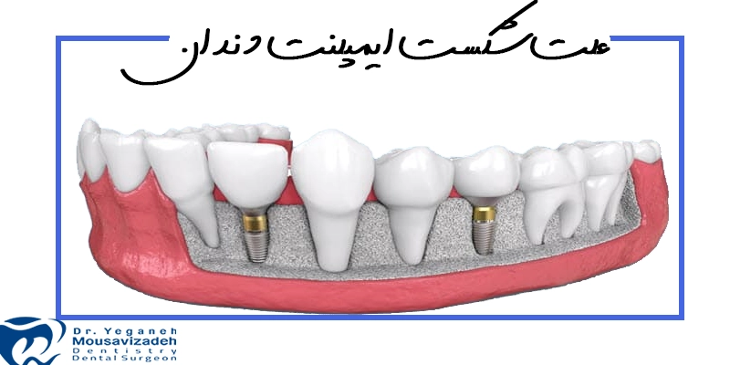 علت شکست ایمپلنت دندان