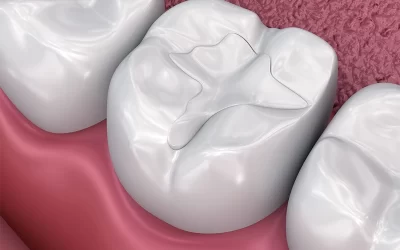 ترمیم کامپوزیت دندان در مشهد