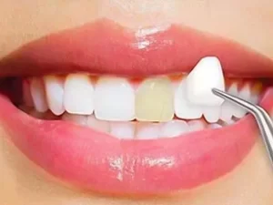 هزینه لمینت دندان