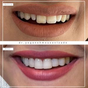 هزینه لمینت دندان، تخصص دندانپزشک