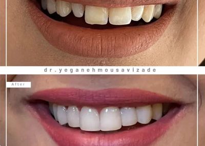 هزینه لمینت دندان، تخصص دندانپزشک