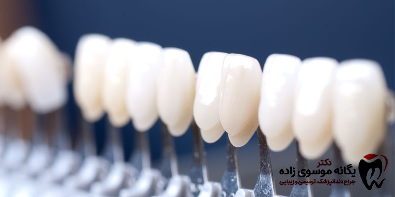 کامپوزیت دندان در مشهد