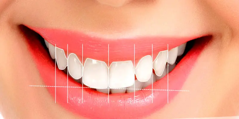 هزینه اصلاح طرح لبخند