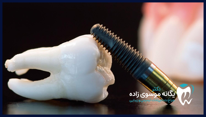 علائم پس زدن ایمپلنت دندان