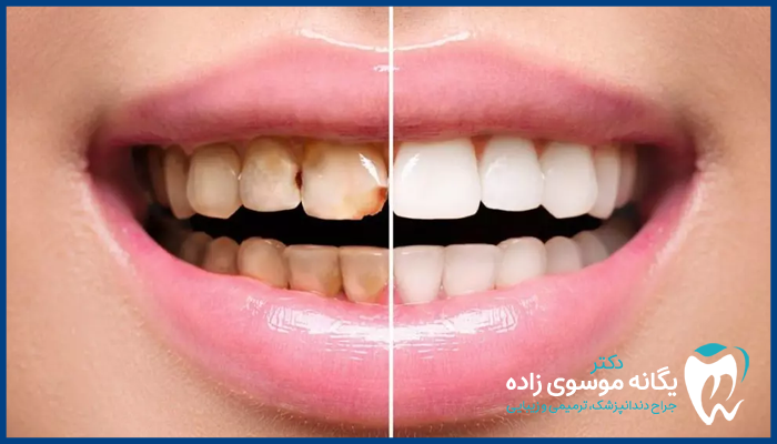 تعویض کامپوزیت دندان چه زمانی لازم است؟
