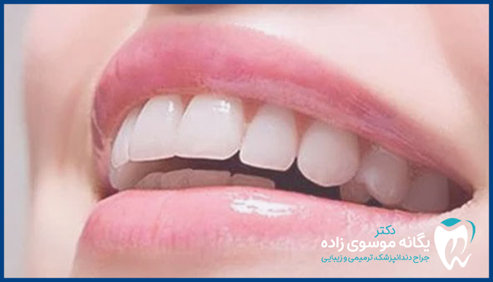 مزایای لمینت سرامیکی دندان
