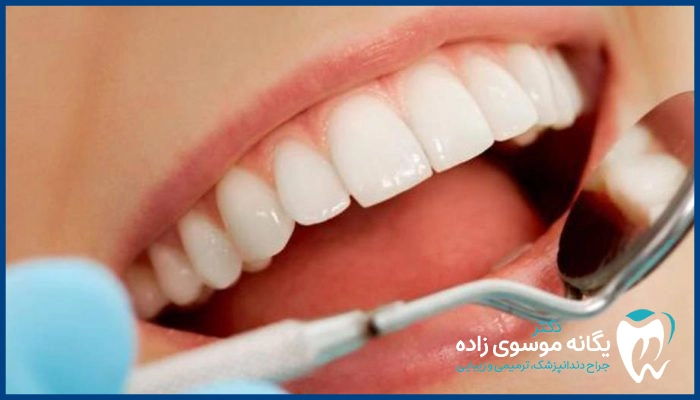 درمان فلوروزیس دندان