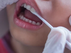 فلوئورزیس دندانی