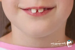 لمینت دندان خرگوشی